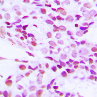 RBMX Antibody - Immunohistochemical analysis of hnRNP G staining in human breast cancer formalin fixed paraffin embedded tissue section. The section was pre-treated using heat mediated antigen retrieval with sodium citrate buffer (pH 6.0). The section was then incubated with the antibody at room temperature and detected using an HRP-conjugated compact polymer system. DAB was used as the chromogen. The section was then counterstained with hematoxylin and mounted with DPX.