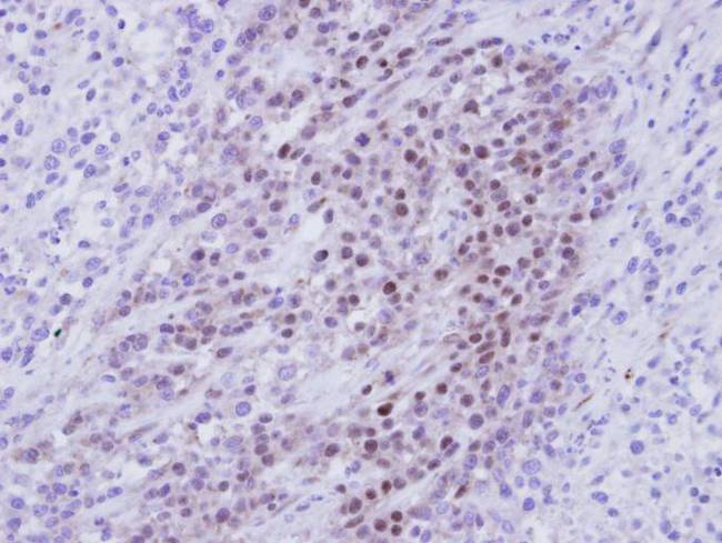 RBMY1A1 Antibody - IHC of paraffin-embedded SAS Xenograft using RBMY1A1 antibody at 1:100 dilution.