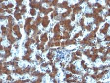 RBP / Retinol Binding Protein Antibody - IHC testing of FFPE human hepatocellular carcinoma and RBP antibody (clone G4E4). This image was taken for the unmodified form of this product. Other forms have not been tested.