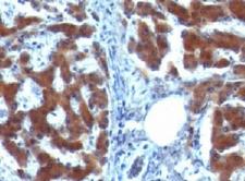 RBP / Retinol Binding Protein Antibody - IHC testing of FFPE human hepatocellular carcinoma with RBP (clone RLBD1).  This image was taken for the unmodified form of this product. Other forms have not been tested.