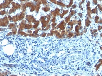 RBP / Retinol Binding Protein Antibody - Formalin-fixed, paraffin-embedded human hepatocellular carcinoma stained with RBP (SPM442).  This image was taken for the unmodified form of this product. Other forms have not been tested.