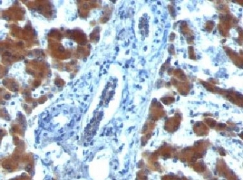 RBP1 / CRBP Antibody - Formalin-fixed, paraffin-embedded human hepatocellular carcinoma stained with RBP1 (RBP/872).  This image was taken for the unmodified form of this product. Other forms have not been tested.