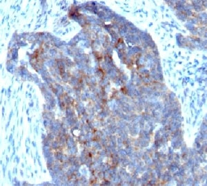 RBP1 / CRBP Antibody - Formalin-fixed, paraffin-embedded human ovarian carcinoma stained with RBP1 (RBP/872).  This image was taken for the unmodified form of this product. Other forms have not been tested.