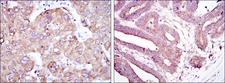 RBP4 Antibody - IHC of paraffin-embedded liver cancer tissues (left) and stomach cancer tissues (right) using RBP4 mouse monoclonal antibody with DAB staining.