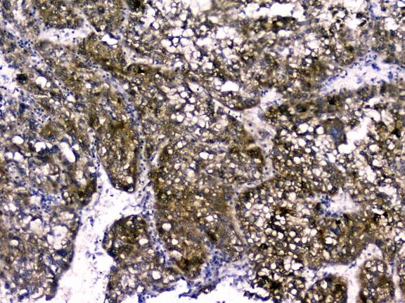 RBP4 Antibody - IHC analysis of RBP4 using anti-RBP4 antibody. RBP4 was detected in paraffin-embedded section of human liver cancer tissues. Heat mediated antigen retrieval was performed in citrate buffer (pH6, epitope retrieval solution) for 20 mins. The tissue section was blocked with 10% goat serum. The tissue section was then incubated with 1µg/ml rabbit anti-RBP4 Antibody overnight at 4°C. Biotinylated goat anti-rabbit IgG was used as secondary antibody and incubated for 30 minutes at 37°C. The tissue section was developed using Strepavidin-Biotin-Complex (SABC) with DAB as the chromogen.