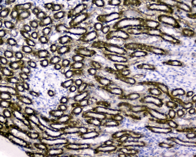 RBP4 Antibody - IHC analysis of RBP4 using anti-RBP4 antibody. RBP4 was detected in paraffin-embedded section of human liver cancer tissues. Heat mediated antigen retrieval was performed in citrate buffer (pH6, epitope retrieval solution) for 20 mins. The tissue section was blocked with 10% goat serum. The tissue section was then incubated with 1µg/ml rabbit anti-RBP4 Antibody overnight at 4°C. Biotinylated goat anti-rabbit IgG was used as secondary antibody and incubated for 30 minutes at 37°C. The tissue section was developed using Strepavidin-Biotin-Complex (SABC) with DAB as the chromogen.