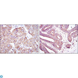 RBP4 Antibody - Immunohistochemistry (IHC) analysis of paraffin-embedded liver cancer tissues (left) and stomach cancer tissues (right) with DAB staining using RBP4 Monoclonal Antibody.
