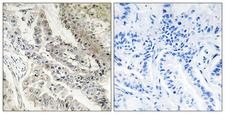RBP5 Antibody - Peptide - + Immunohistochemistry analysis of paraffin-embedded human lung carcinoma tissue, using CRBP III antibody.