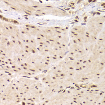 RBPJ Antibody - Immunohistochemistry of paraffin-embedded Human gastric cancer tissue.