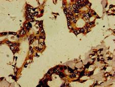 RBPJL Antibody - Immunohistochemistry image of paraffin-embedded human pancreatic cancer at a dilution of 1:100