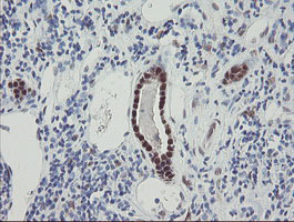 RBPMS / Hermes Antibody - IHC of paraffin-embedded Carcinoma of Human kidney tissue using anti-RBPMS mouse monoclonal antibody.