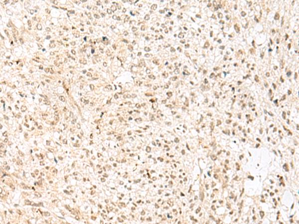 RBX1 / ROC1 Antibody - Immunohistochemistry of paraffin-embedded Human liver cancer tissue  using RBX1 Polyclonal Antibody at dilution of 1:50(×200)