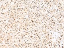 RBX1 / ROC1 Antibody - Immunohistochemistry of paraffin-embedded Human liver cancer tissue  using RBX1 Polyclonal Antibody at dilution of 1:50(×200)