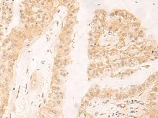 RBX1 / ROC1 Antibody - Immunohistochemistry of paraffin-embedded Human liver cancer tissue  using RBX1 Polyclonal Antibody at dilution of 1:30(×200)