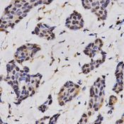 RCAN1 / DSCR1 Antibody - Immunohistochemistry of paraffin-embedded human breast cancer using RCAN1 antibody at dilution of 1:200 (x400 lens).
