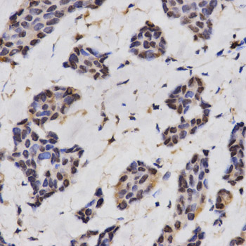 RCAN1 / DSCR1 Antibody - Immunohistochemistry of paraffin-embedded human breast cancer using RCAN1 antibody at dilution of 1:200 (x400 lens).