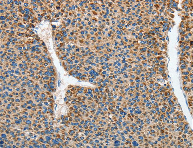 RCAN1 / DSCR1 Antibody - Immunohistochemistry of paraffin-embedded Human liver cancer using RCAN1 Polyclonal Antibody at dilution of 1:45.