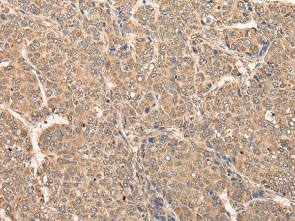 RCAN3 / Calcipressin 3 Antibody - Immunohistochemistry of paraffin-embedded Human liver cancer tissue  using RCAN3 Polyclonal Antibody at dilution of 1:60(×200)