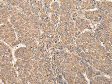 RCAN3 / Calcipressin 3 Antibody - Immunohistochemistry of paraffin-embedded Human liver cancer tissue  using RCAN3 Polyclonal Antibody at dilution of 1:60(×200)
