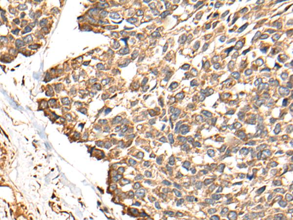 RCAN3 / Calcipressin 3 Antibody - Immunohistochemistry of paraffin-embedded Human esophagus cancer tissue  using RCAN3 Polyclonal Antibody at dilution of 1:60(×200)