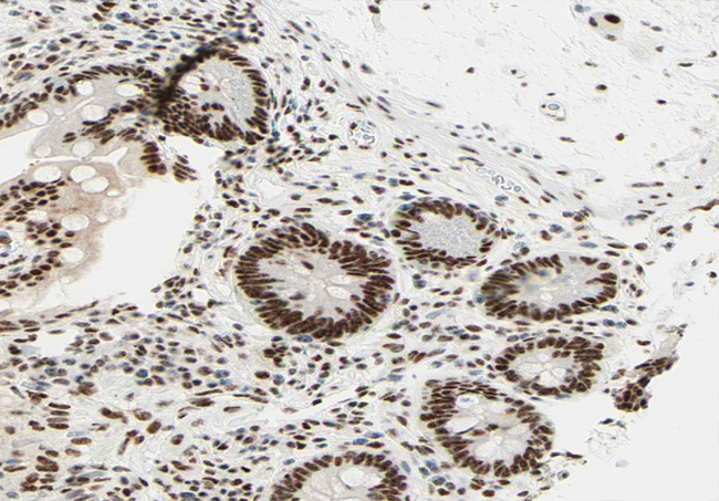 RCBTB1 Antibody - 1:100 staining human colon carcinoma tissue by IHC-P. The tissue was formaldehyde fixed and a heat mediated antigen retrieval step in citrate buffer was performed. The tissue was then blocked and incubated with the antibody for 1.5 hours at 22°C. An HRP conjugated goat anti-rabbit antibody was used as the secondary.