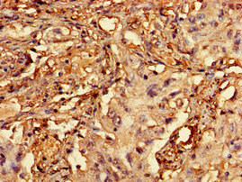 RCBTB2 Antibody - Immunohistochemistry of paraffin-embedded human lung cancer using RCBTB2 Antibody at dilution of 1:100