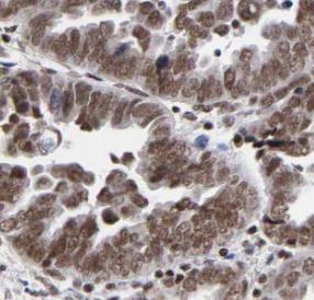 RCC1 Antibody - Immunohistochemistry of paraffin-embedded human ovary tumor using phospho-CHC1 (Ser12) antibody at dilution of 1:50