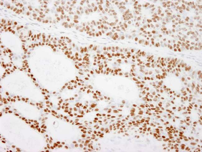 RCC2 Antibody - Detection of Human RCC2 by Immunohistochemistry. Sample: FFPE section of human basal cell carcinoma. Antibody: Affinity purified rabbit anti-RCC2 used at a dilution of 1:500.