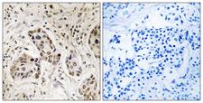 RCC2 Antibody - Peptide - + Immunohistochemistry analysis of paraffin-embedded human breast carcinoma tissue using RCC2 antibody.