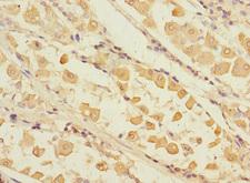 RCHY1 / PIRH2 Antibody - Immunohistochemistry of paraffin-embedded human gastric cancer at dilution 1:100