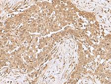 RCHY1 / PIRH2 Antibody - Immunohistochemistry of paraffin-embedded Human esophagus cancer tissue  using RCHY1 Polyclonal Antibody at dilution of 1:50(×200)