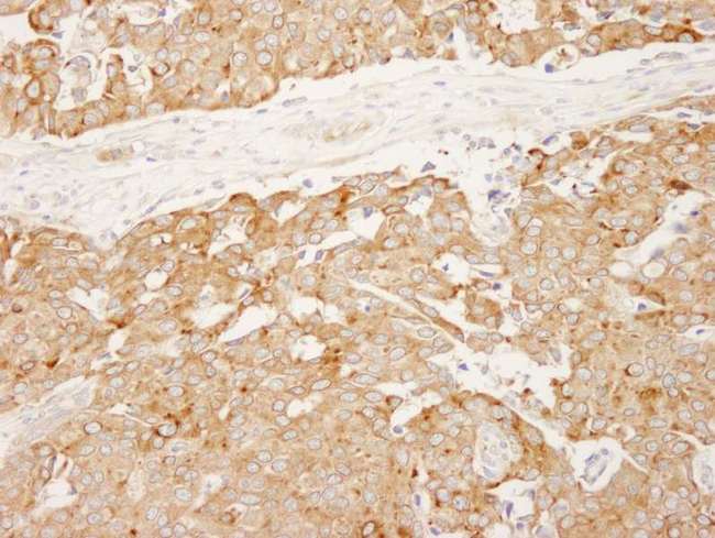 RCN1 / Reticulocalbin 1 Antibody - Detection of Human Reticulocalbin by Immunohistochemistry. Sample: FFPE section of human breast carcinoma. Antibody: Affinity purified rabbit anti-Reticulocalbin used at a dilution of 1:250.