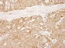 RCN1 / Reticulocalbin 1 Antibody - Detection of Human Reticulocalbin by Immunohistochemistry. Sample: FFPE section of human breast carcinoma. Antibody: Affinity purified rabbit anti-Reticulocalbin used at a dilution of 1:250.