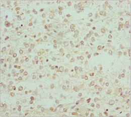 RCN2 Antibody - Immunohistochemistry of paraffin-embedded human glioma cancer at dilution 1:100