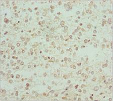 RCN2 Antibody - Immunohistochemistry of paraffin-embedded human glioma cancer at dilution 1:100