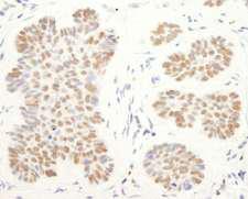 RCOR1 / COREST Antibody - Detection of Human CoREST by Immunohistochemistry. Sample: FFPE section of human skin carcinoma. Antibody: Affinity purified rabbit anti-CoREST used at a dilution of 1:5000 (0.2 ug/ml).