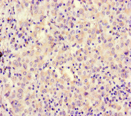 RCOR1 / COREST Antibody - Immunohistochemistry of paraffin-embedded human lung cancer at dilution of 1:100
