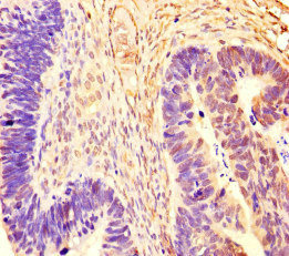 RCOR1 / COREST Antibody - Immunohistochemistry of paraffin-embedded human ovarian cancer at dilution of 1:100