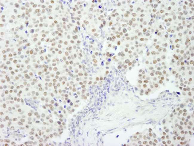 RCOR3 Antibody - Detection of Human RCOR3 by Immunohistochemistry. Sample: FFPE section of human breast carcinoma. Antibody: Affinity purified rabbit anti-RCOR3 used at a dilution of 1:250.