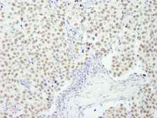 RCOR3 Antibody - Detection of Human RCOR3 by Immunohistochemistry. Sample: FFPE section of human breast carcinoma. Antibody: Affinity purified rabbit anti-RCOR3 used at a dilution of 1:250.