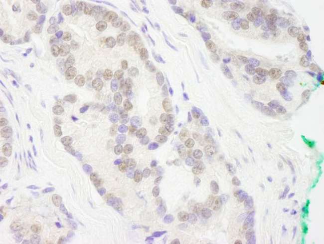 RCOR3 Antibody - Detection of Human RCOR3 by Immunohistochemistry. Sample: FFPE section of human prostate carcinoma. Antibody: Affinity purified rabbit anti-RCOR3 used at a dilution of 1:250.