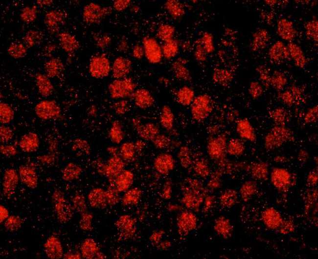 RCOR3 Antibody - Detection of human RCOR3 by immunohistochemistry. Sample: FFPE section of human breast carcinoma. Antibody: Affinity purified rabbit anti-RCOR3 used at a dilution of 1:100. Detection: Red-fluorescent goat anti-rabbit IgG highly cross-adsorbed Antibody used at a dilution of 1:100.