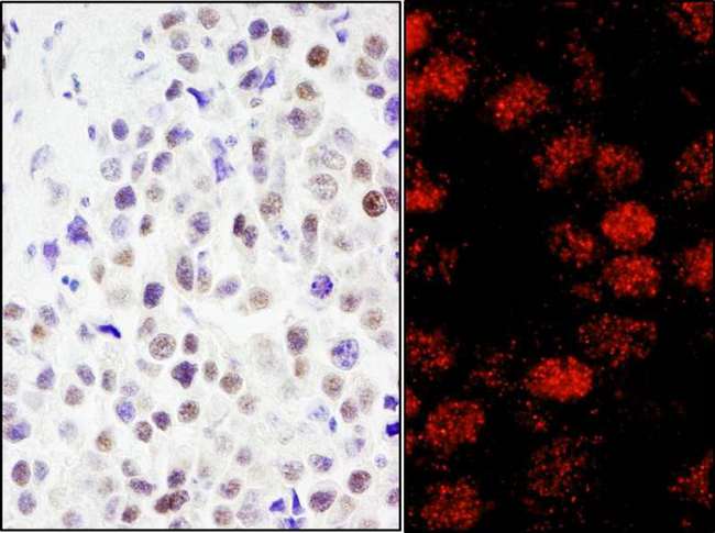 RCOR3 Antibody - Detection of Human RCOR3 by Immunohistochemistry and Immunofluorescence. Sample: FFPE sections of human testicular seminoma (left) and breast carcinoma (right). Antibody: Affinity purified rabbit anti-RCOR3 used at a dilution of 1:200 (1 ug/ml) and 1:80 (2.5 ug/ml). Detection: DAB and Red-fluorescent Goat anti-Rabbit IgG-heavy and light chain, cross-adsorbed Antibody DyLight 594 Conjugated used at a dilution of 1:100.