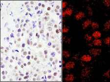 RCOR3 Antibody - Detection of Human RCOR3 by Immunohistochemistry and Immunofluorescence. Sample: FFPE sections of human testicular seminoma (left) and breast carcinoma (right). Antibody: Affinity purified rabbit anti-RCOR3 used at a dilution of 1:200 (1 ug/ml) and 1:80 (2.5 ug/ml). Detection: DAB and Red-fluorescent Goat anti-Rabbit IgG-heavy and light chain, cross-adsorbed Antibody DyLight 594 Conjugated used at a dilution of 1:100.