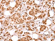 RCOR3 Antibody - Immunohistochemistry of paraffin-embedded Human breast cancer tissue  using RCOR3 Polyclonal Antibody at dilution of 1:60(×200)
