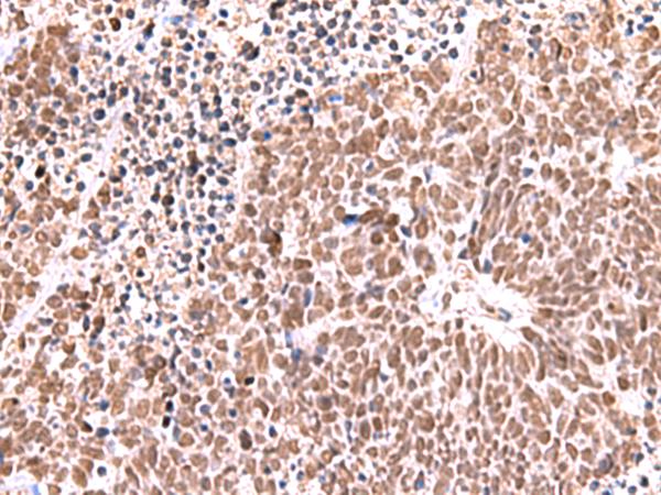 RCOR3 Antibody - Immunohistochemistry of paraffin-embedded Human lung cancer tissue  using RCOR3 Polyclonal Antibody at dilution of 1:60(×200)