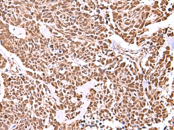 RCOR3 Antibody - Immunohistochemistry of paraffin-embedded Human lung cancer tissue  using RCOR3 Polyclonal Antibody at dilution of 1:55(×200)
