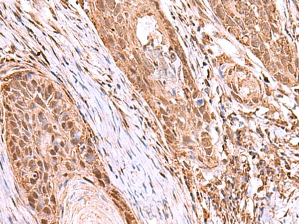 RCOR3 Antibody - Immunohistochemistry of paraffin-embedded Human esophagus cancer tissue  using RCOR3 Polyclonal Antibody at dilution of 1:55(×200)