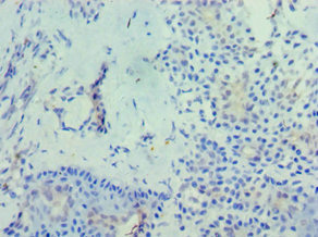RD / PHYH Antibody - Immunohistochemistry of paraffin-embedded human breast cancer using PHYH Antibody at dilution of 1:100