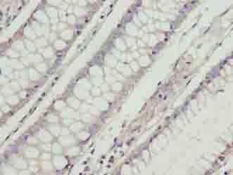 RD3 Antibody - Immunohistochemistry of paraffin-embedded human colon cancer using antibody at dilution of 1:100.